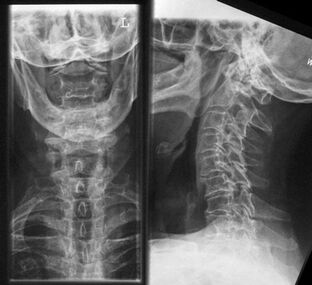 Röntgen der Halswirbelsäule eine Methode zur Diagnose von Osteochondrose