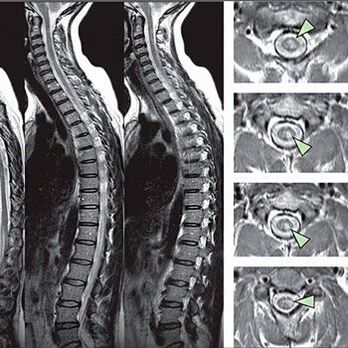 Diagnose der thorakalen Osteochondrose