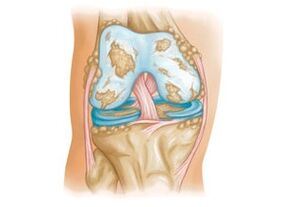 Schäden am Kniegelenk bei Arthrose