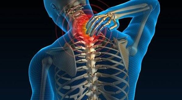 Osteochondritis der Wirbelsäule