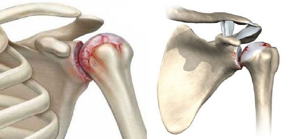 Zerstörung des Schultergelenks bei Arthrose