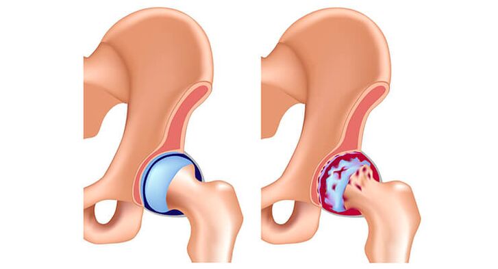 Gesundes und arthritisches Hüftgelenk